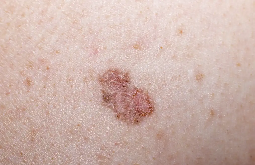 closeup of skin cancer cells
