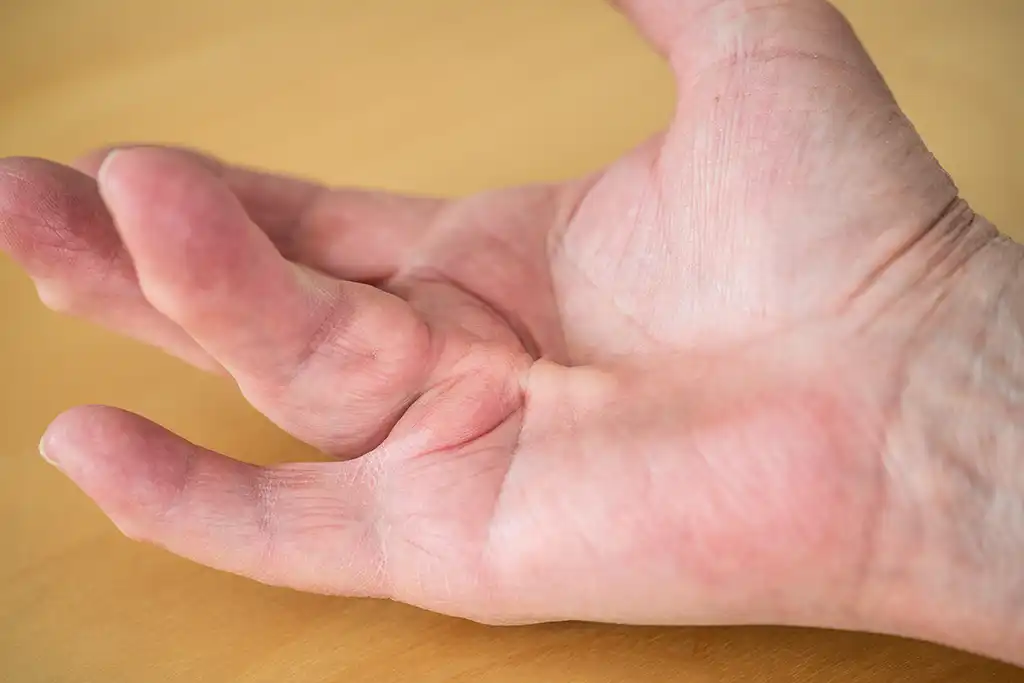 individuals hand showing a defect